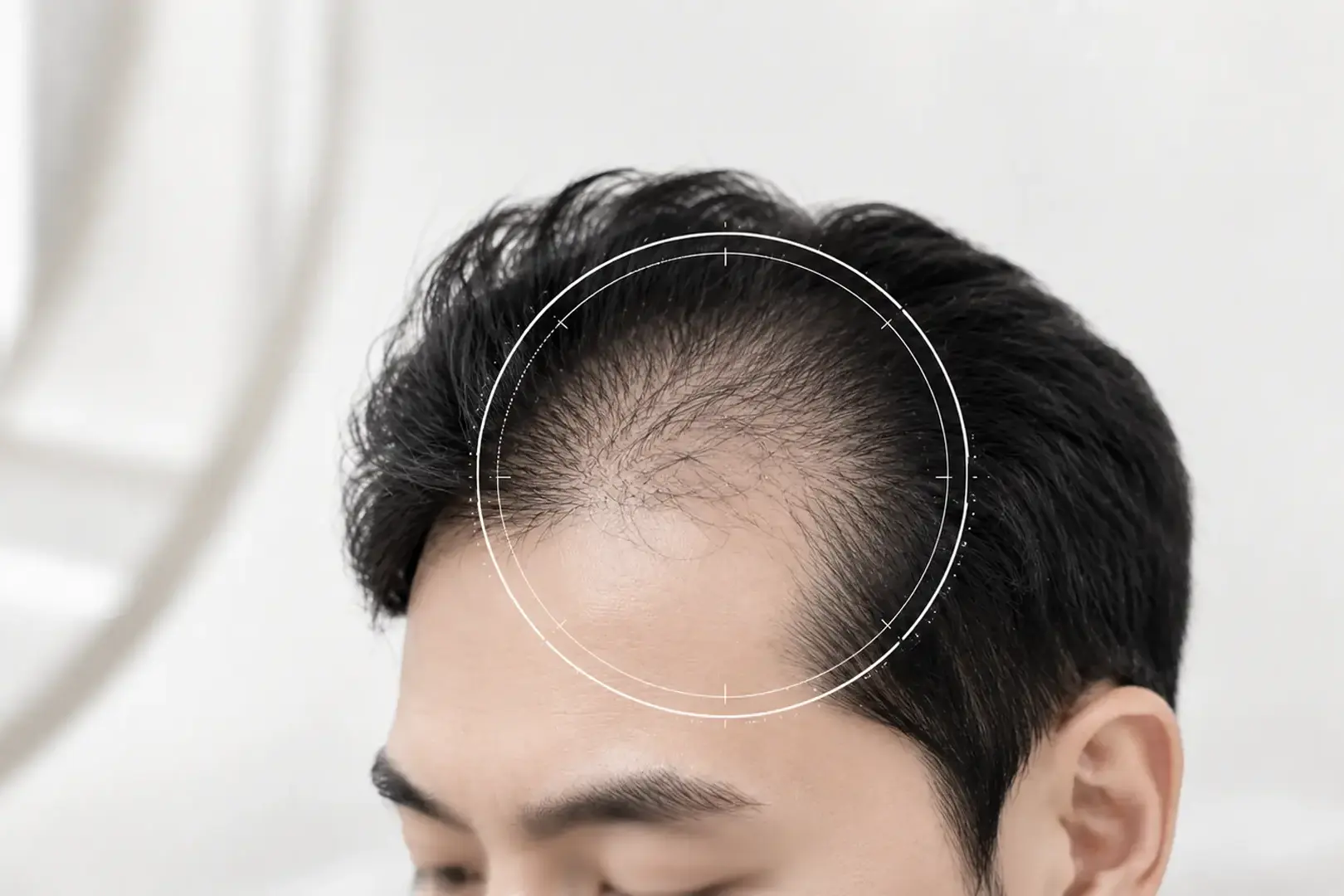 대구 비타민나무의원에서 남성형 탈모의 헤어라인 후퇴와 진행 양상을 확인하는 진료 이미지